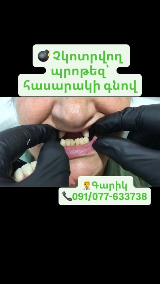 #պրոթեզ #պրոթեզավորում #ատամներիպրոթեզավորում #չկոտրվողպրոթեզ#պրոթեզա…