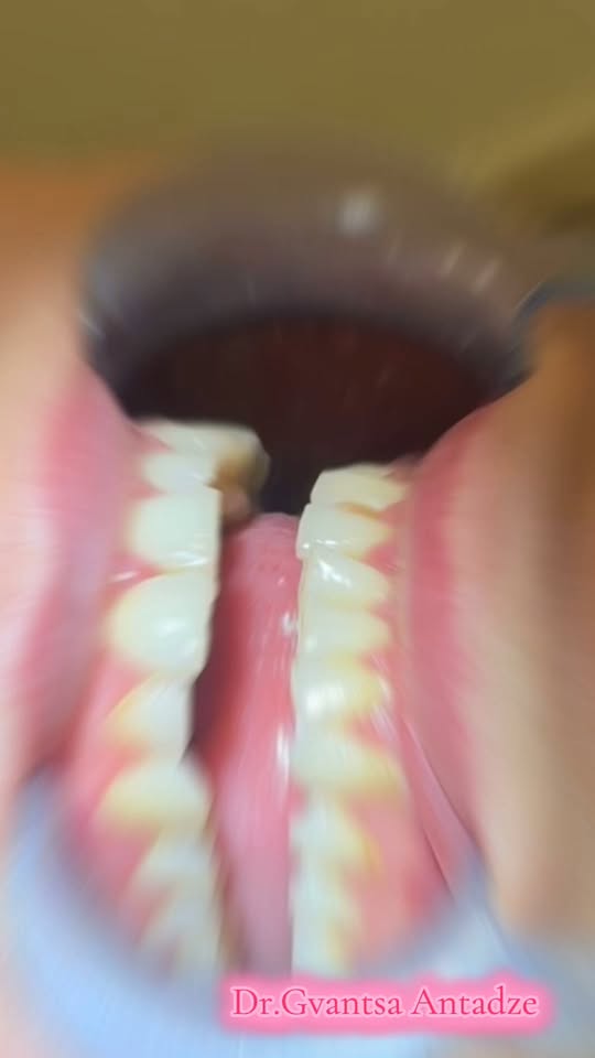 Акция на чистку и отбеливание 🦷