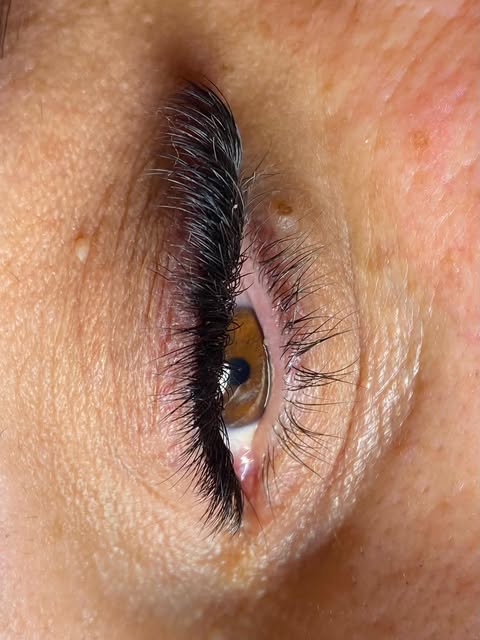 We offer stem cell extension of pimples correctly